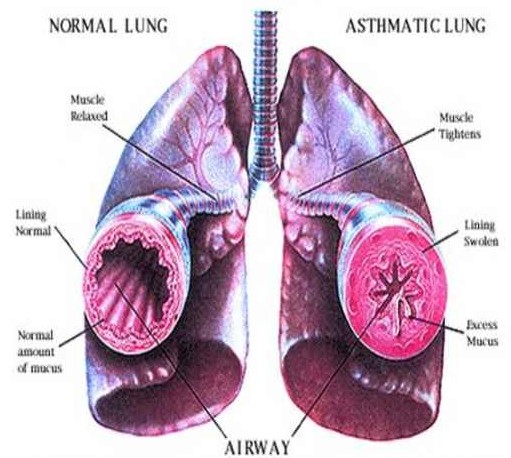 exercise induced asthma